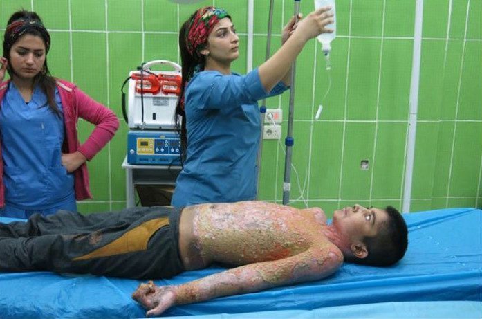 Terör örgüt PKK yandaşları, tişörtü yanan bir çocuğun hastanedeki görüntülerini, 'TSK kimyasal silah kullanıyor' diye servis etti. 