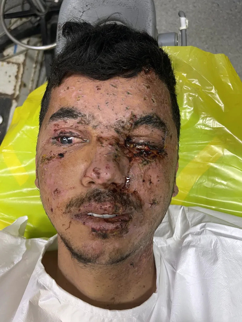Gazze'deki 10 günlük tıbbî görevi sırasında Dr. Han, İsrail saldırılarında yaralanan çok sayıda çocuk ve yetişkinin gözlerini aldığı ameliyatlar yaptı. Han, bu yaygın yaralanmaları, "Gazze'nin şarapnel yüzü" olarak tanımlıyor.